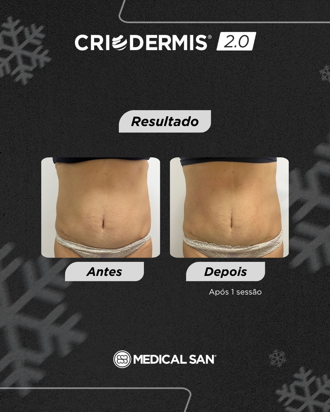Antes e depois de criolipólise — Criodermis 2.0